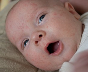 Baby Eczema