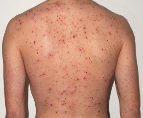 How to Get Rid of Back Acne